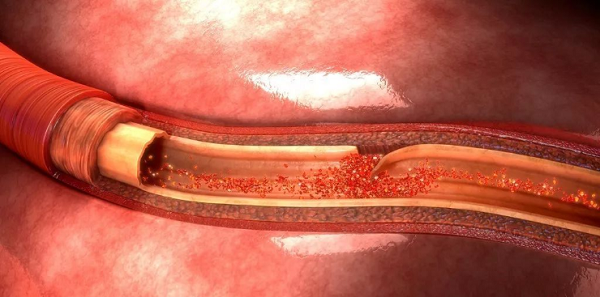 頸動(dòng)脈夾層是中青年腦卒中受檢者重要誘因 頸動(dòng)脈夾層是中青年腦卒中受檢者重要誘因