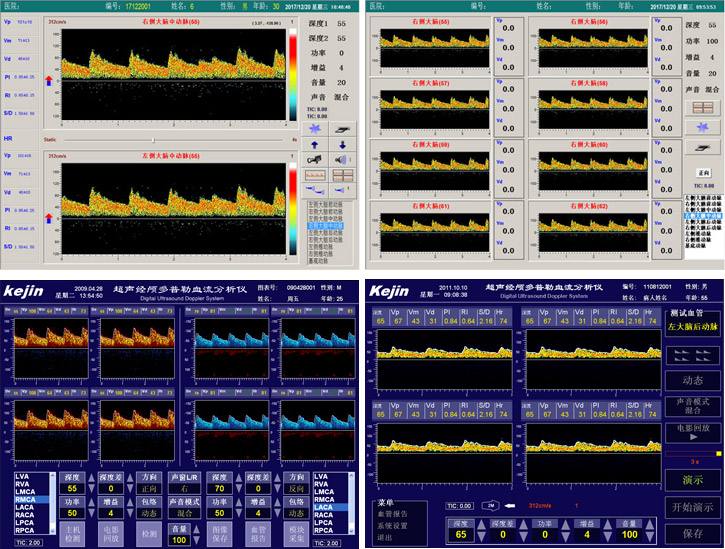 TCD血管定位技術(shù)實現(xiàn)自動搜索血管信號 TCD血管定位技術(shù)實現(xiàn)自動搜索血管信號