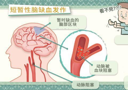 短暫性腦缺血是什么 經(jīng)顱多普勒可確診 短暫性腦缺血是什么 經(jīng)顱多普勒可確診